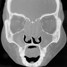 Aspergillosis occurs in chronic or acute forms which are clinically very distinct. Allergic Aspergillosis Of The Respiratory Tract European Respiratory Society