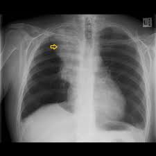 Image result for lung cancer xray