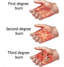 Maybe you would like to learn more about one of these? The Top 4 Homeopathic Remedies To Heal Burns The Healing Haven Homeopathic Dispensary