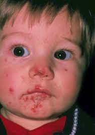 Lesen sie, für wen diese keime bedrohlich sein können und wie sie sich und andere schützen können. Staphylococcus Aureus Infektionen Infektionen Msd Manual Ausgabe Fur Patienten