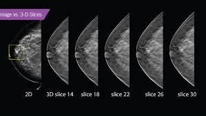 It appears to be developing in a concentric pattern. 3d Mammogram Another Way To Detect Cancer