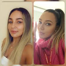 My first before and after photo post since surgery. Still very swollen but  can't wait to see final result. 5 weeks and 4 days post op.