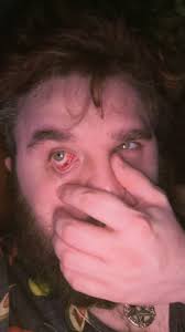 Popped Blood Vessel in Eye from Coughing