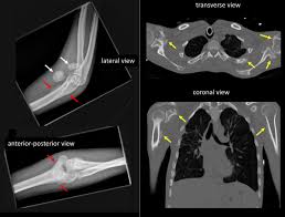Image result for periostitis