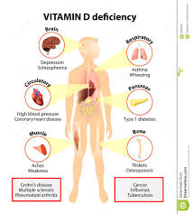 Mangel Des Vitamins D Symptome Und Krankheiten Vektor Abbildung Illustration Von Leber Verursacht 56608207