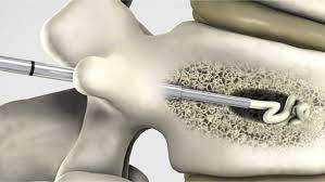 Les médecins en ont parlé à rbc. Cimentoplastie Vertebrale Et Cyphoplastie Espace Francilien Du Rachis