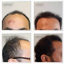 Before And After Dramatic Results Natural Transplant S State Of The Art Hair Transplant Facility In F Hair Transplant Hair Restoration Best Hair Transplant