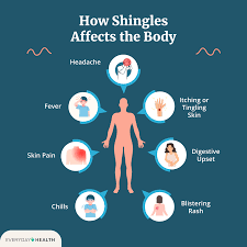 Image result for shingles