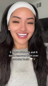 Correcting Overcrowded Teeth with Braces: Before and After