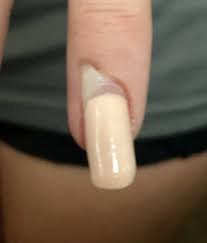 What caused my acrylic nails to lift? Hit My Acrylic Nail Resulting In Lifting My Real Nail And I Believe Pushing The Nail Bed To Skin Nail Disorders Forums Patient