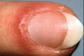 Image result for Akutní zánět nehtového lůžka