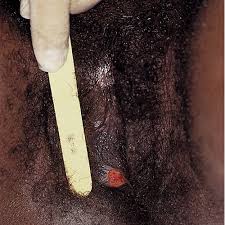 Image result for syphilis symptoms