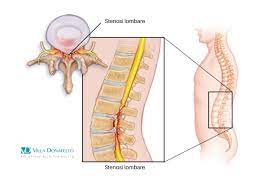 Steno´ses) an abnormal narrowing or contraction of a body passage or opening; Stenosi Lombare A Villa Donatello I Primi Interventi In Italia Con Trattamento Tecnica Endoscopica Mininvasiva