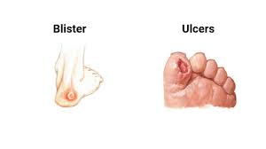 When this happens, the vessels in the dermis can move up to the epidermis.this can be especially painful in the mouth, where the skin is soft and regularly exposed to a wide range of protrusions and substances. Foot Ulcers Blisters What S The Difference Siren Diabetes
