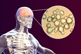 Cryptococcal Meningitis May Be Linked With Higher Mortality in ...