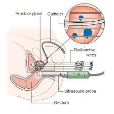 Prostate Cancer Symptoms Diagnosis Treatment Urology Care Foundation