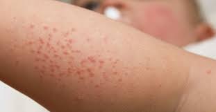 Image result for sweat rash on back