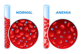 Image result for Anemia