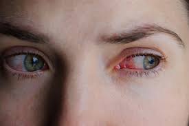 Pink Eye Vs Allergies Causes Symptoms And Treatment Stuffy Nose Remedy Treating Sinus Infection Pink Eyes