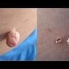 Pueden crecer rápidamente en los párpados, el cuello y las axilas. 3