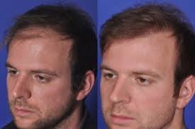 FUE Hair Restoration — PēkoMD: Dr. Daniel Straka