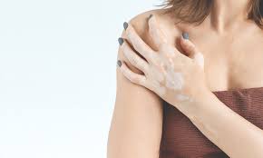 Image result for robert zaruba vitiligo