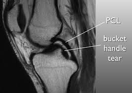 Double Pcl Sign Appears On Sagittal Mri Images Of The Knee When A Bucket Handle Tear Of A Meniscus Most Commonly The Me Radiology Knee Mri Radiology Imaging