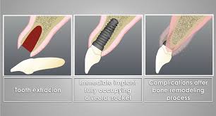 Any time you have a tooth extracted, your remaining teeth are liable to shift. Update On Timing Of Implant Placement After Tooth Extraction Oral Health Group