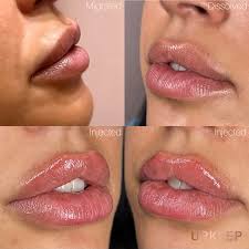 Dissolving Fillers: Everything You Need To Know – Racquel Frisella