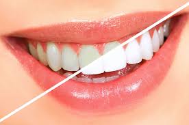 Most commonly, orthodontic treatment involves the attachment of metal brackets to the front (or back) of your teeth. Getting Whiter Teeth While You Have Braces Orthodontist