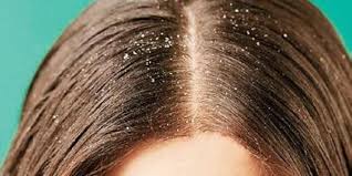 Certain conditions can cause an itchy scalp and hair loss. Dandruff Versus Dry Scalp The New Indian Express