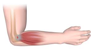 Tennisellenbogen, epicondylitis humeri radialis, epicondylitis humeri lateralis. Liza Tennisarm Liza