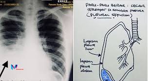 Paru paru berair yang kecil tidak memerlukan rawatan tetapi punca berlakunya paru paru berair perlu dikenalpasti dan dirawat. Paru Paru Berair Sebab Mandi Malam Baca Ulasan Doktor Pakar Majalah Ilmu