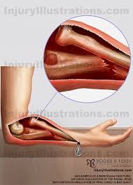 Image result for Radial Head Dislocation