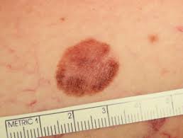 It's estimated that in the united states, more than 3.3 million people types of skin cancer: Superficial Spreading Melanoma Dermnet Nz