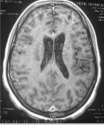 Image result for AIDS Dementia Complex