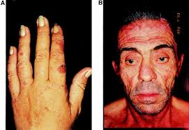 Skin diseases associated with hepatitis C virus infection