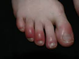 Jul 12, 2021 · borax is an increasingly popular natural remedy for a whole host of health issues. How To Treat Chilblains At Home The Footcare Clinic
