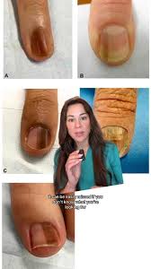 Image result for Acral lentiginous melanoma nail
