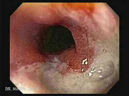 Esophagitis, also spelled oesophagitis, is a disease characterized by inflammation of the esophagus. Esophagitis El Atlas Gastrointestinal Gastrointestinalatlas Com