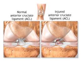 The knee is made up of four main things: Anterior Cruciate Ligament Acl Injury Masnad Health Clinic