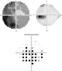 Image result for Visual Field Deficit