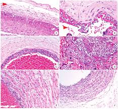 Image result for Chorioamnionitis