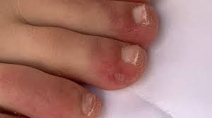 Other causes for cracks between toes can arise from contact dermatitis or skin infections. Coronavirus Covid Toe And Other Rashes Puzzle Doctors Bbc News