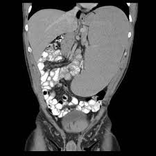 Image result for Splenomegaly