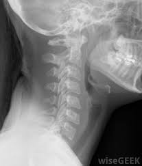 What is the Cervical Vertebrae? (with pictures)