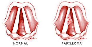 If you have oropharyngeal cancer, cancer cells form in the middle of the throat, including the tongue, tonsils, and pharynx walls. Hpv And Throat Cancer Causes Symptoms And Treatment