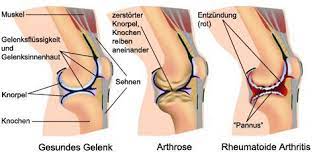 Rheumatoide Arthritis Chronische Polyarthritis Cp Netdoktor At