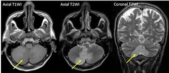 Image result for Pica