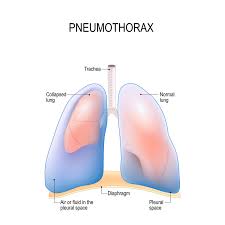 Image result for Pneumothorax